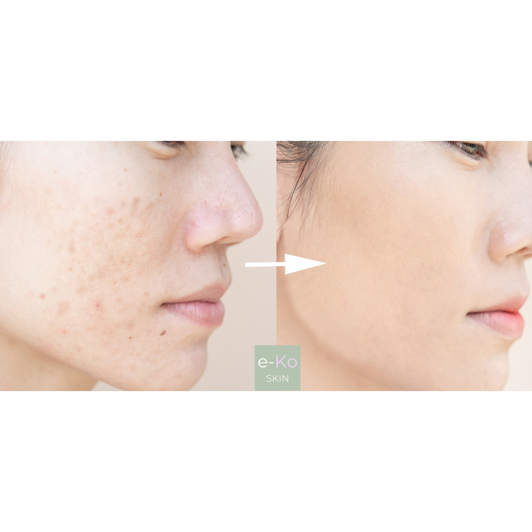 Anua - Azelaic Acid 10 - Ser calmant pentru roșeață - e-Ko Skin (Image 2)