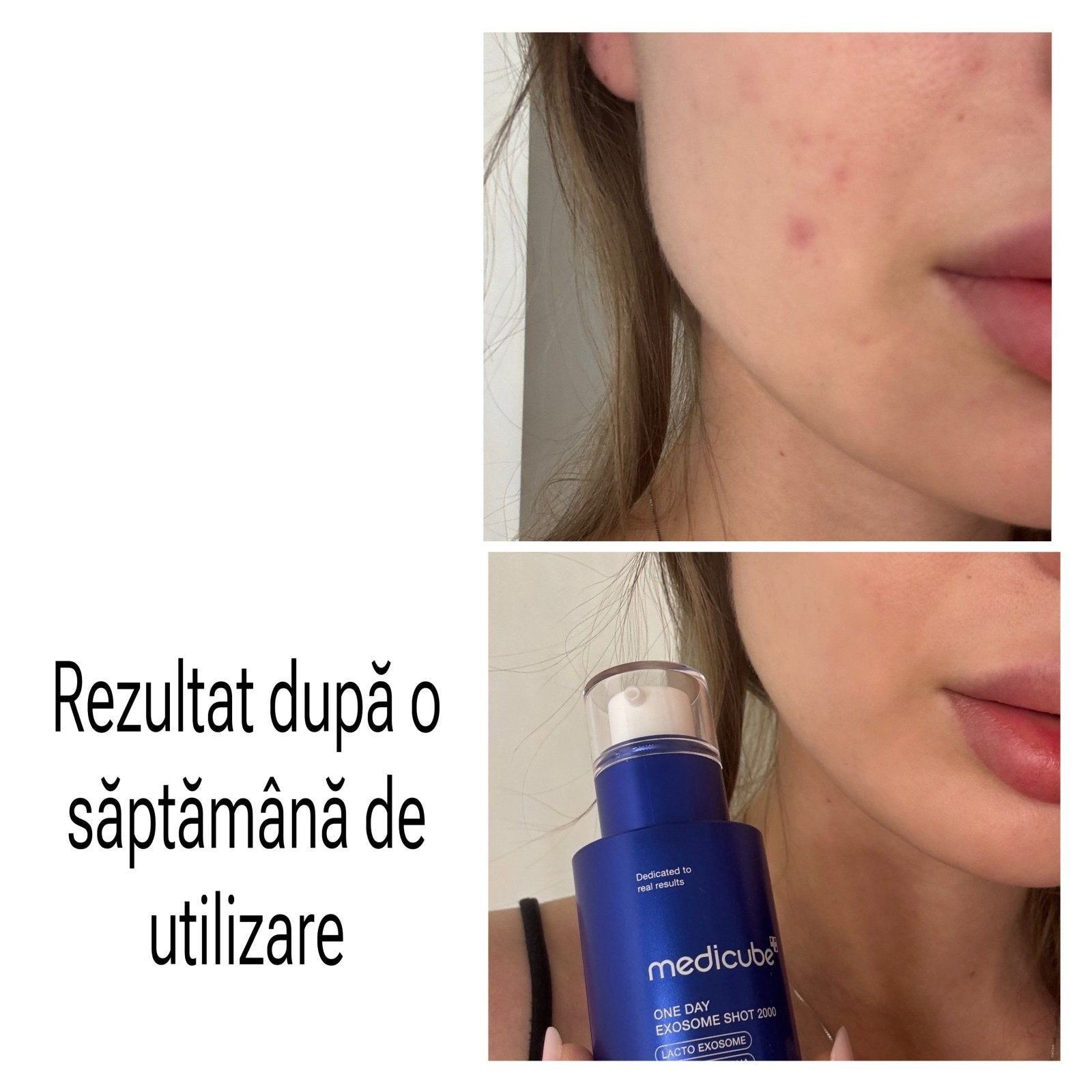 medicube - One Day Exosome Shot Pore Ampoule 2000 - ser cu exozomi, 30ml - e-Ko Skin ser de fata