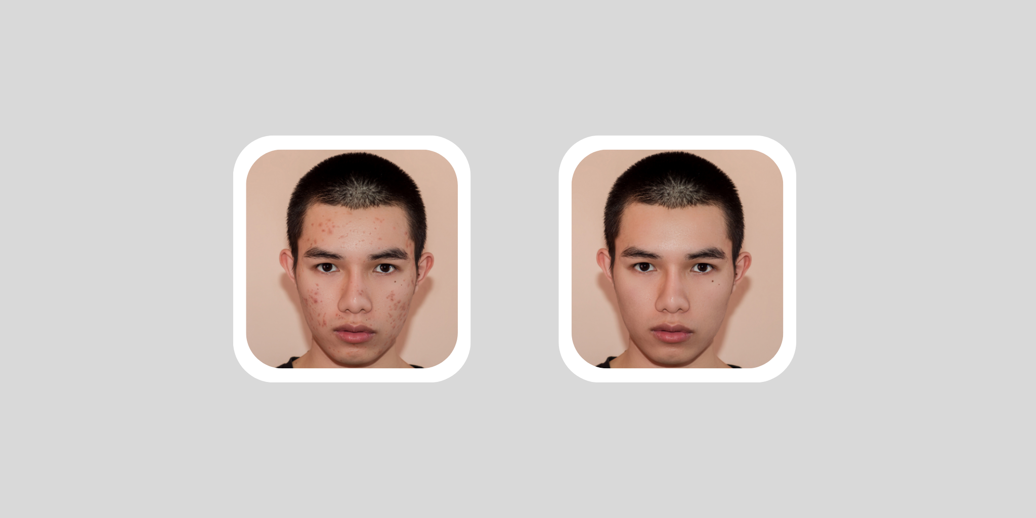 Rozacee, cuperoză și acnee: cum le deosebești