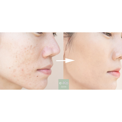 Anua - Azelaic Acid 10 - Ser calmant pentru roșeață - e-Ko Skin (Image 2)